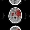 腦出血後怎麼血壓控制？早期降壓治療：130-140 mmHg最科學