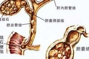 天冷了膽囊結石卻「興奮」了，十個結石九個發作到底是為什麼?