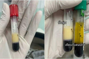 酗酒男送醫抽出「牛奶血」 醫揭啤酒肚成因：等於直接喝油