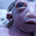 驚！可憐女嬰出生時「隻有半顆頭」，雙眼腫如外星人！隻因母親做了「這件事」…最後女嬰竟然…