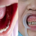 不到兩歲就滿口「黑牙」，醫生提出警告．．．再不改正「這些行為」，連新長出來的牙齒都會是黑的