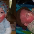 兩歲寶寶臉頰上開始出現紅點，醫生以為是濕疹，沒想到後來媽媽請求結束兒子生命...實在太可怕了！