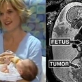女嬰在媽媽肚子裡與巨大腫瘤一起成長共處，為了救她一命醫生竟然做出這種事...簡直駭人聽聞！