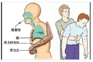 魚刺卡到喉嚨別拍背，救了100萬人的神奇急救法！