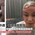 丈夫有外遇，，元配氣得燒炭成自焚！毀容慘住ICU渣男甜牽小三拍婚紗