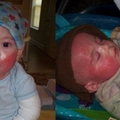 兩歲寶寶臉頰出現紅點，醫生以為是濕疹開藥治療，沒想到寶寶竟因此全身滲出不明液體，皮膚像是「融化」一樣！