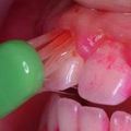 男子把「牙齦流血」當成牙周病　沒想到竟是「血癌」!