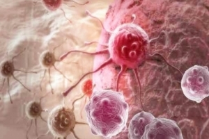 原來癌細胞是靠「它」才能長大變強，罹癌者只要沒有「它」癌細胞就會死光光！腫瘤縮小3分之1，連身體也健康了！