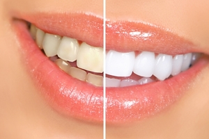 美白牙齒讓你擁有迷人微笑！牙齒變黃的原因可能有「這幾種」！