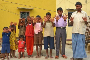 印度有個家族每人有12個手指和12個腳趾