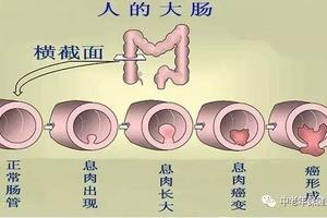 結腸息肉的病因有哪些？ 怎樣預防結腸息肉？