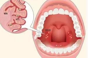 偶爾咳出米白色惡臭顆粒是什麼？口臭可能是因為它