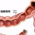 別把腸息肉拖成腸癌！腸內長了息肉，身體會有3種異常，不可大意