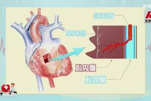 心慌、心悸，可能是心臟的「牆」出了問題