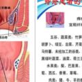 痔瘡吃什麼好？分內痔、外痔、混合痔三種，臨床治療