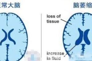 年齡大了，不是記憶力差了，而是腦萎縮了