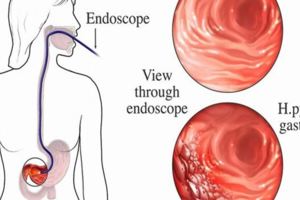 符合這4個特徵，就是胃病在癌變，再不治療就危險了！
