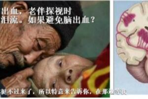 72歲腦出血，老伴探視時讓醫生淚流。如果避免腦出血？